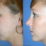 What You Need to Know About Chin Augmentation Surgery