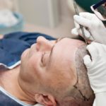 What is hair transplant surgery